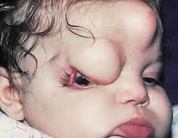 Ophthalmic equipment for retina surgery at Wavikar Eye Institute