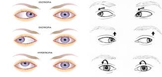 Eye surgery preparation at Wavikar Eye Institute