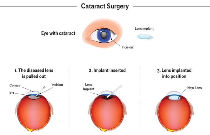 Illustration of cataract surgery procedure