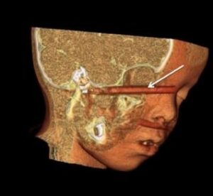 3D-CT reconstruction of a child who fell on a writing pen. The pen entered the right