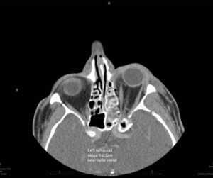 Left sphenoid sinus fracture near optic canal