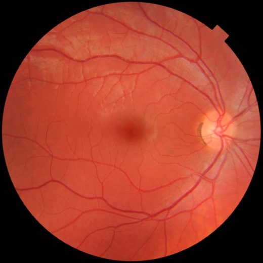 Fundus photograph of normal right eye