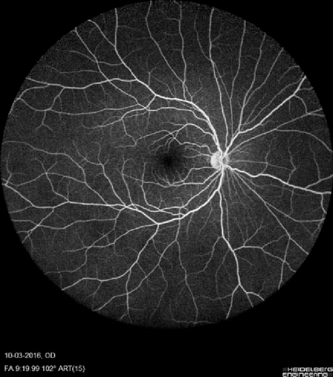 Wide-field fundus fluorescein angiography image