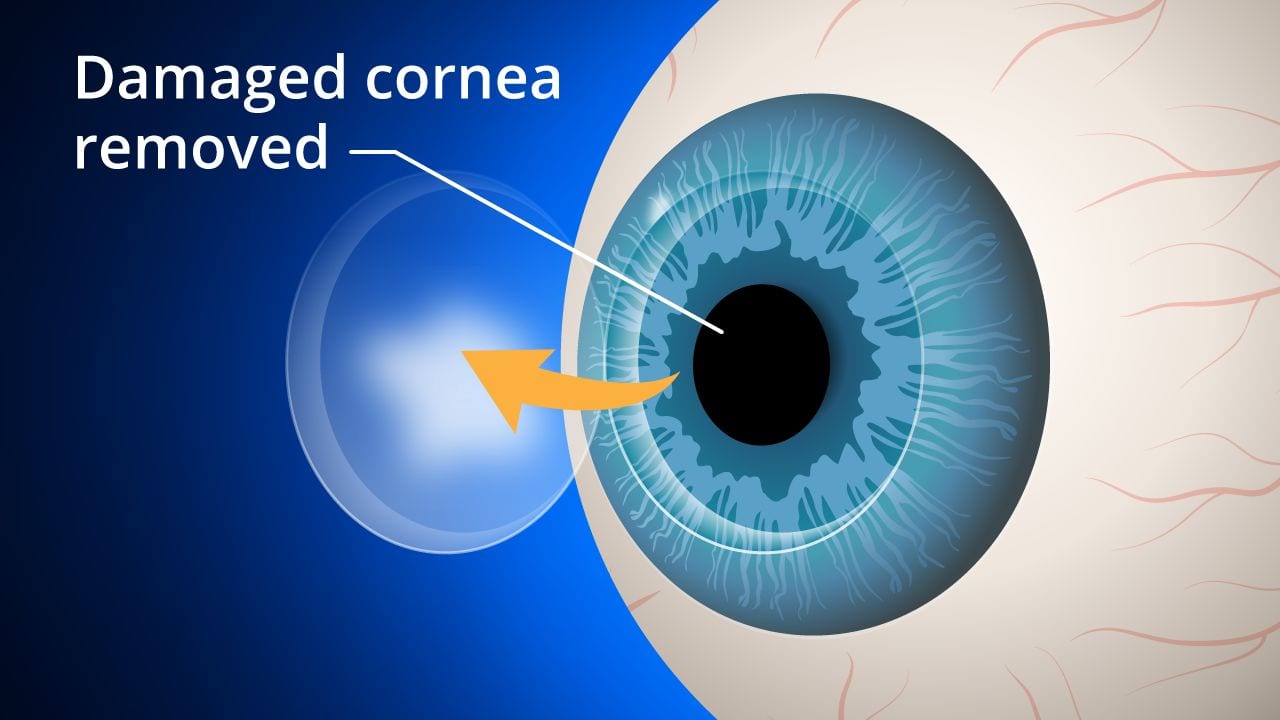 Cornea transplant procedure in progress