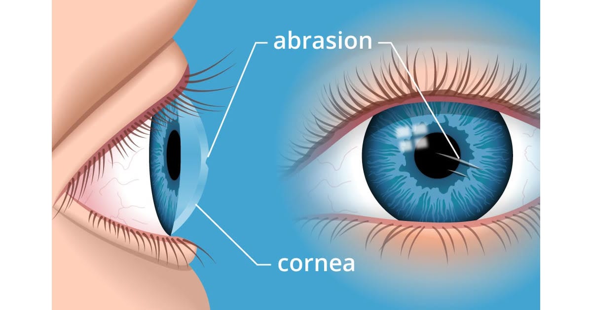 Detailed image of corneal abrasion