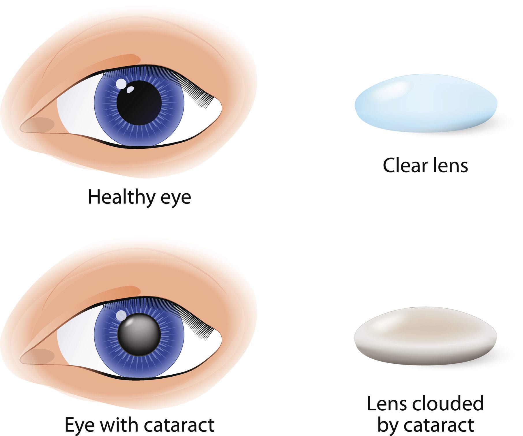 Wavikar Eye Institute catract services