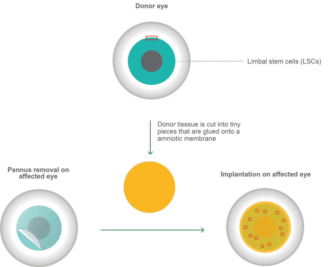 Illustration of limbal stem cell deficiency