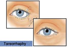 Surgical procedure known as tarsorrhaphy in progress