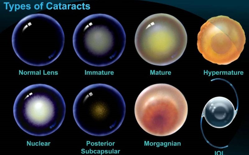 Cataract Treatment in Thane