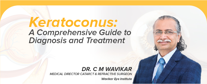 Keratoconus: A Comprehensive Guide to Diagnosis and Treatment