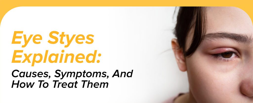 Eye Styes Explained: Causes, Symptoms, And How To Treat Them
